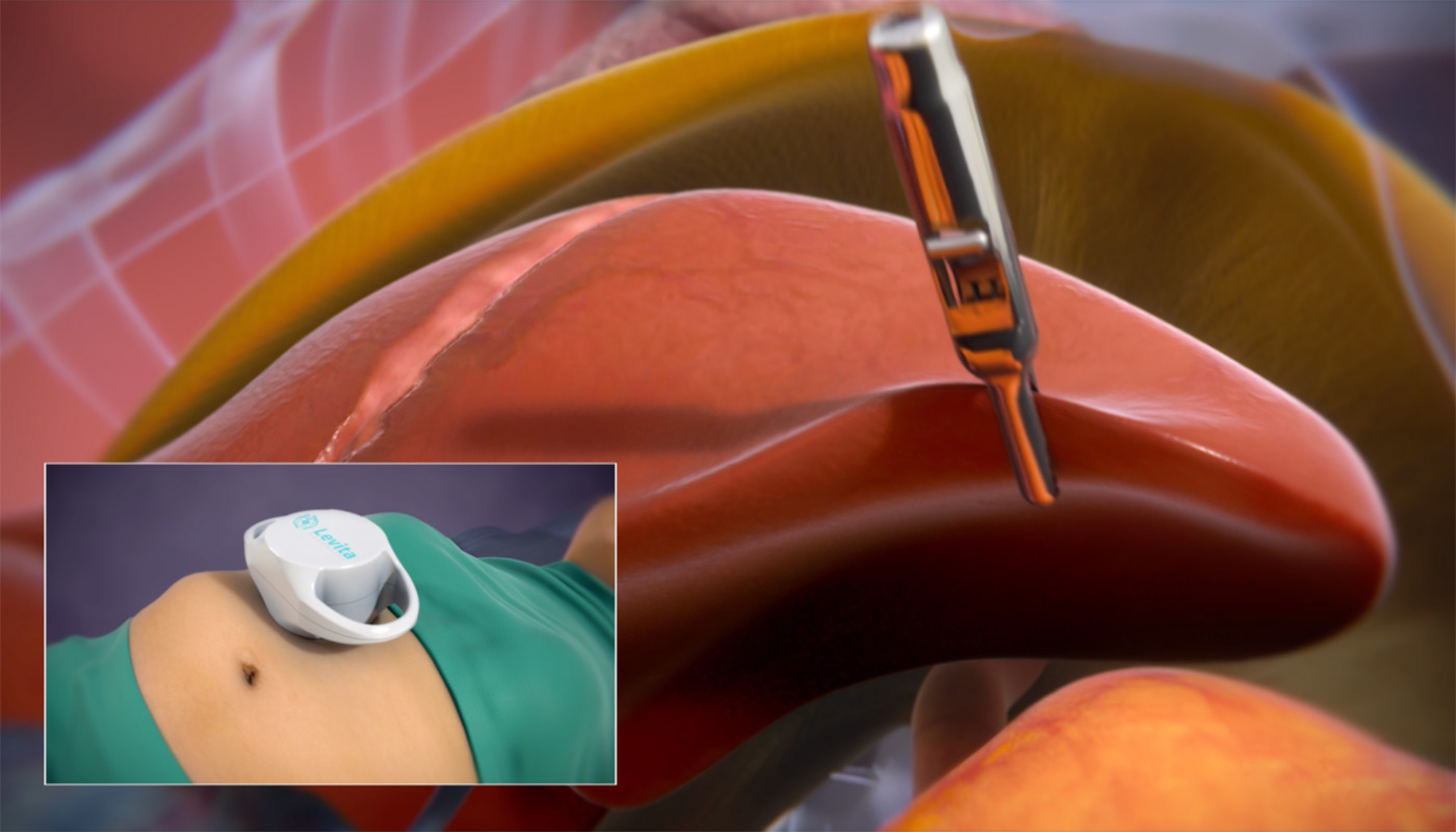 Levita® Magnetics Announces Publication of Clinical Data for Magnetic Surgical System for Less Invasive Bariatric Surgery