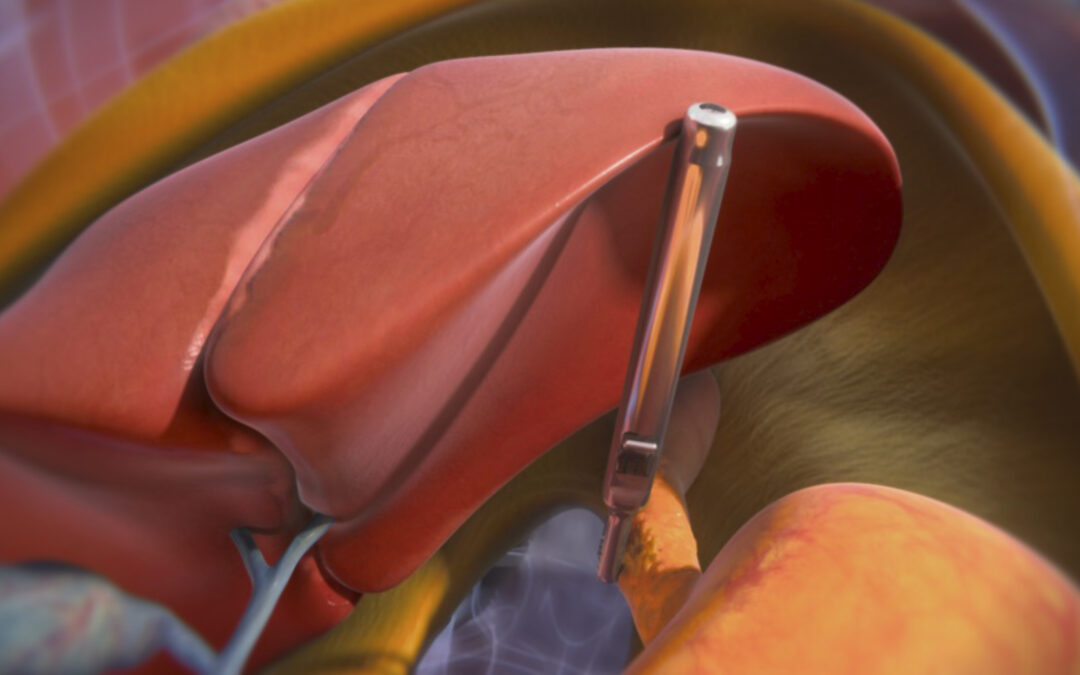 FDA Expands Indication for Levita Magnetics’ Magnetic Surgical System with MARS® for Minimally Invasive Bariatric and Hiatal Hernia Repair